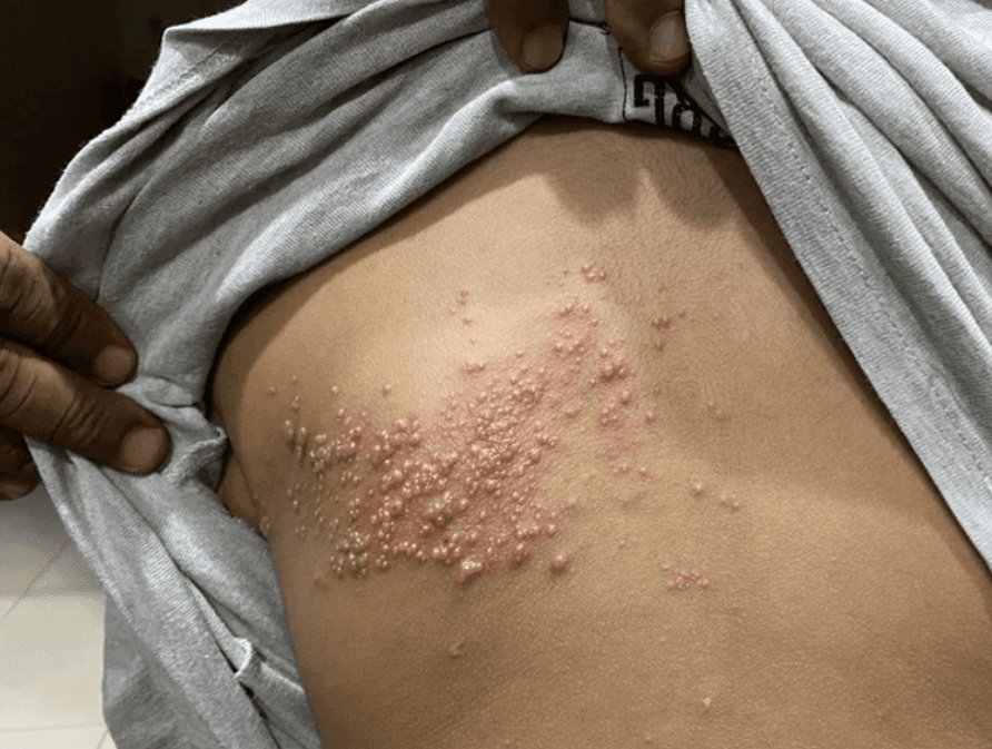 Zona Artık Sadece Yaşlıların Hastalığı Değil: Gençlerde Artış Dikkat Çekiyor